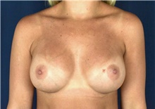 Breast Augmentation After Photo by Michael Frederick, MD; Fort Lauderdale, FL - Case 39755