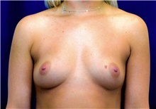Breast Augmentation Before Photo by Michael Frederick, MD; Fort Lauderdale, FL - Case 39755