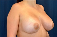 Breast Augmentation After Photo by Michael Frederick, MD; Fort Lauderdale, FL - Case 39769
