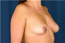 Breast Augmentation Before Photo by Michael Frederick, MD; Fort Lauderdale, FL - Case 39769
