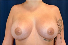 Breast Augmentation After Photo by Michael Frederick, MD; Fort Lauderdale, FL - Case 39769