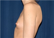 Breast Augmentation Before Photo by Michael Frederick, MD; Fort Lauderdale, FL - Case 39771