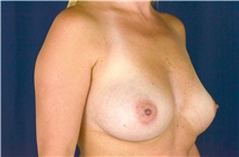 Breast Augmentation Before Photo by Michael Frederick, MD; Fort Lauderdale, FL - Case 39773