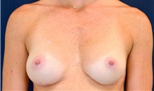 Breast Augmentation After Photo by Michael Frederick, MD; Fort Lauderdale, FL - Case 39775