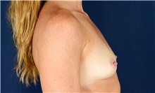 Breast Augmentation Before Photo by Michael Frederick, MD; Fort Lauderdale, FL - Case 39775
