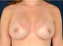 Breast Augmentation After Photo by Michael Frederick, MD; Fort Lauderdale, FL - Case 39776
