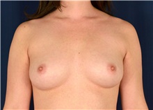 Breast Augmentation Before Photo by Michael Frederick, MD; Fort Lauderdale, FL - Case 39776