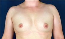 Breast Augmentation Before Photo by Michael Frederick, MD; Fort Lauderdale, FL - Case 39778