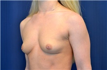 Breast Augmentation Before Photo by Michael Frederick, MD; Fort Lauderdale, FL - Case 39780
