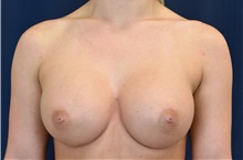 Breast Augmentation After Photo by Michael Frederick, MD; Fort Lauderdale, FL - Case 39780