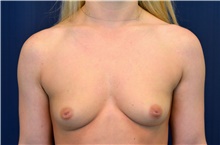 Breast Augmentation Before Photo by Michael Frederick, MD; Fort Lauderdale, FL - Case 39780