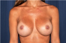 Breast Augmentation After Photo by Michael Frederick, MD; Fort Lauderdale, FL - Case 39781