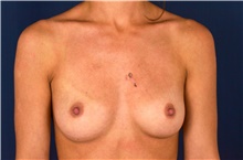 Breast Augmentation Before Photo by Michael Frederick, MD; Fort Lauderdale, FL - Case 39781