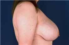 Breast Lift Before Photo by Michael Frederick, MD; Fort Lauderdale, FL - Case 39782