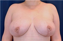 Breast Lift After Photo by Michael Frederick, MD; Fort Lauderdale, FL - Case 39782