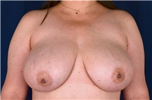 Breast Lift Before Photo by Michael Frederick, MD; Fort Lauderdale, FL - Case 39782