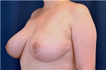 Breast Lift After Photo by Michael Frederick, MD; Fort Lauderdale, FL - Case 39782