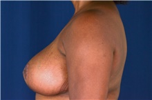 Breast Reduction After Photo by Michael Frederick, MD; Fort Lauderdale, FL - Case 39787