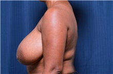 Breast Reduction Before Photo by Michael Frederick, MD; Fort Lauderdale, FL - Case 39787