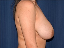 Breast Lift Before Photo by Michael Frederick, MD; Fort Lauderdale, FL - Case 39790