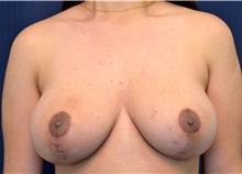 Breast Lift After Photo by Michael Frederick, MD; Fort Lauderdale, FL - Case 39790