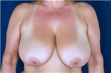 Breast Reduction Before Photo by Michael Frederick, MD; Fort Lauderdale, FL - Case 39794
