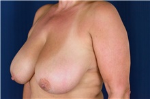 Breast Reduction Before Photo by Michael Frederick, MD; Fort Lauderdale, FL - Case 39794