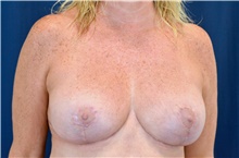 Breast Lift After Photo by Michael Frederick, MD; Fort Lauderdale, FL - Case 39798