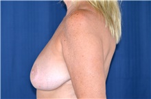 Breast Lift Before Photo by Michael Frederick, MD; Fort Lauderdale, FL - Case 39798