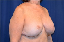 Breast Reconstruction After Photo by Michael Frederick, MD; Fort Lauderdale, FL - Case 39799