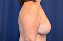 Breast Reconstruction After Photo by Michael Frederick, MD; Fort Lauderdale, FL - Case 39799