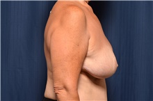 Breast Reconstruction Before Photo by Michael Frederick, MD; Fort Lauderdale, FL - Case 39799