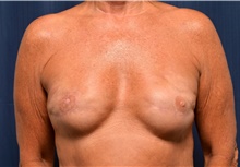 Breast Reconstruction After Photo by Michael Frederick, MD; Fort Lauderdale, FL - Case 39800