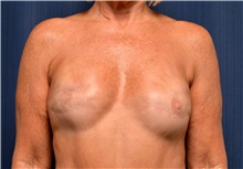 Breast Reconstruction Before Photo by Michael Frederick, MD; Fort Lauderdale, FL - Case 39800
