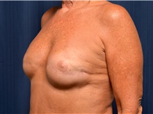 Breast Reconstruction After Photo by Michael Frederick, MD; Fort Lauderdale, FL - Case 39800