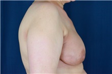 Breast Reconstruction After Photo by Michael Frederick, MD; Fort Lauderdale, FL - Case 39814