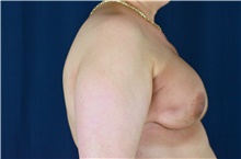Breast Reconstruction Before Photo by Michael Frederick, MD; Fort Lauderdale, FL - Case 39814