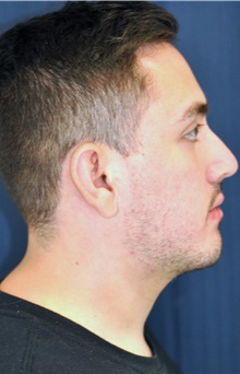 Chin Augmentation After Photo by Michael Frederick, MD; Fort Lauderdale, FL - Case 39815