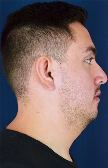 Chin Augmentation Before Photo by Michael Frederick, MD; Fort Lauderdale, FL - Case 39815