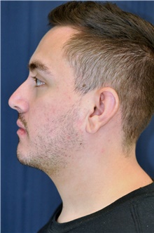 Chin Augmentation After Photo by Michael Frederick, MD; Fort Lauderdale, FL - Case 39815