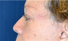 Eyelid Surgery After Photo by Michael Frederick, MD; Fort Lauderdale, FL - Case 39818