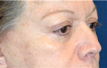 Eyelid Surgery After Photo by Michael Frederick, MD; Fort Lauderdale, FL - Case 39818