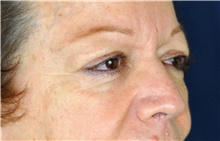 Eyelid Surgery Before Photo by Michael Frederick, MD; Fort Lauderdale, FL - Case 39818