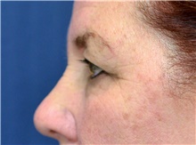 Eyelid Surgery Before Photo by Michael Frederick, MD; Fort Lauderdale, FL - Case 39821