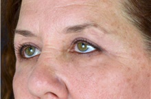 Eyelid Surgery After Photo by Michael Frederick, MD; Fort Lauderdale, FL - Case 39821