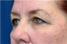 Eyelid Surgery Before Photo by Michael Frederick, MD; Fort Lauderdale, FL - Case 39821