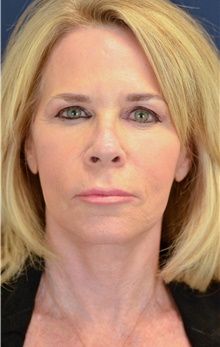 Facelift After Photo by Michael Frederick, MD; Fort Lauderdale, FL - Case 39824