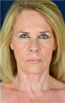 Facelift Before Photo by Michael Frederick, MD; Fort Lauderdale, FL - Case 39824