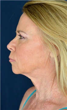 Facelift Before Photo by Michael Frederick, MD; Fort Lauderdale, FL - Case 39824