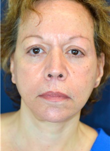 Facelift After Photo by Michael Frederick, MD; Fort Lauderdale, FL - Case 39830